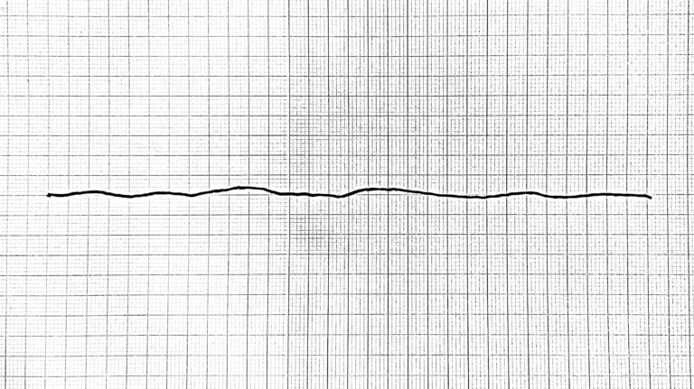 Asystole EKG