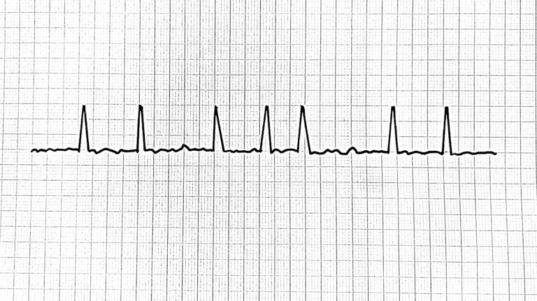 FA Fibrillaatio atriorum eteisvärinä Flimmeri Förmaksflimmer fibrillatio atriorum artial fibrillation