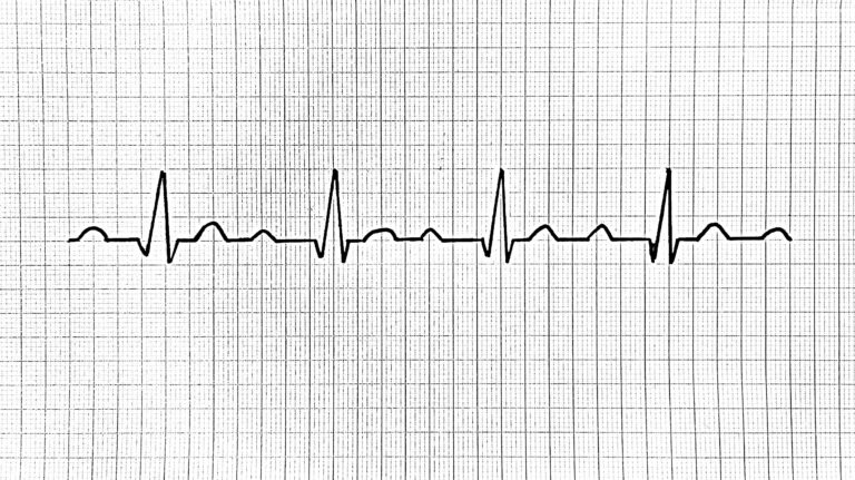 Ensimmäisen asteen AV-katkos ekg first degree av block ecg första gradens av-block ekg