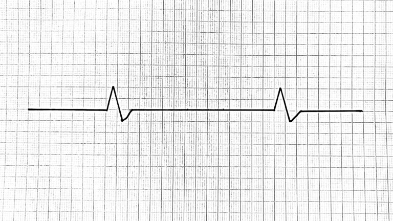 Pulseless electrical activity PEA EKG ECG