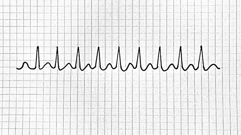 Supraventrikulaarinen takykardia SVT supraventricular tachycardia Supraventrikulär takykardi