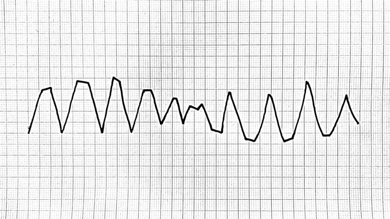 TdP torsades de pointes ECG kääntyvien kärkien kammiotakykardia EKG