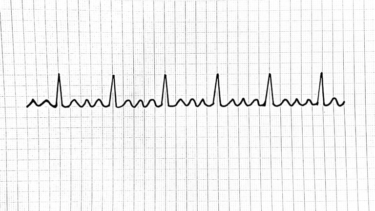 VA volitatio atriorum eteislepatus flutteri förmaksflutter