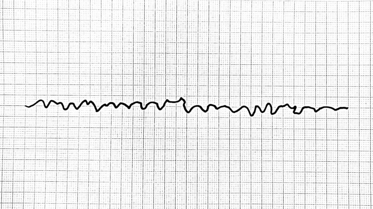 VF ventricular fibrillation kammiovärinä kammarflimmer EKG ECG