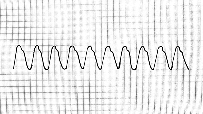 VT Ventricular tachycardia kammiotakykardia kammartakykardi EKG ECG